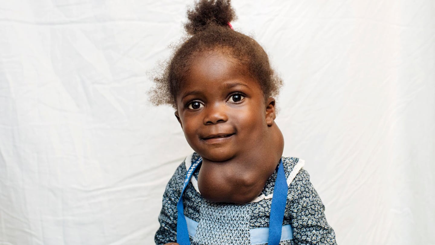 Mercy Ships, Umu med tumör på halsen innan operation.